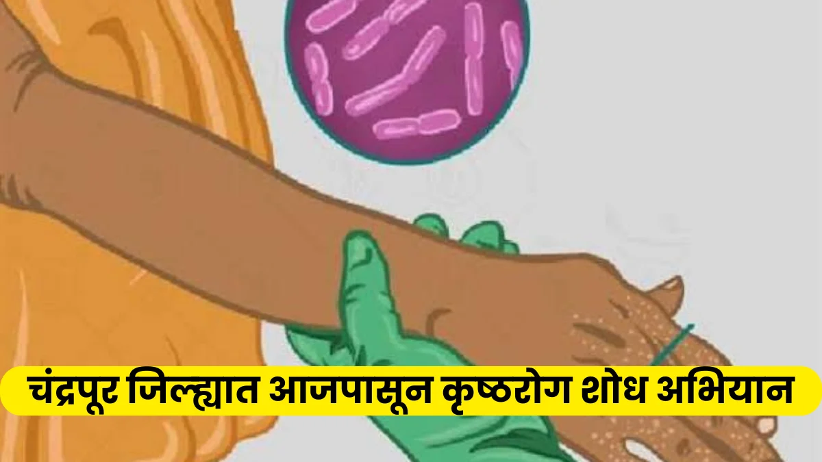 National Leprosy Eradication Programme | चंद्रपूर जिल्ह्यात आज पासून कुष्ठरोग शोध अभियान
